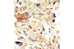 Formalin-fixed and paraffin-embedded human cancer tissue reacted with the primary antibody, which was peroxidase-conjugated to the secondary antibody, followed by AEC staining. (EGFR antibody  (N-Term))
