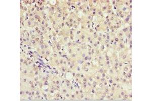 Immunohistochemistry of paraffin-embedded human liver cancer using ABIN7143586 at dilution of 1:100 (AKR7A2 antibody  (AA 100-359))