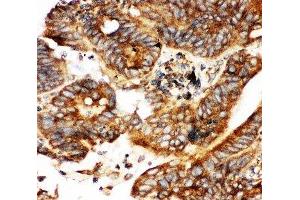 IHC-P testing of human intestinal cancer tissue (CALB1 antibody  (AA 2-175))