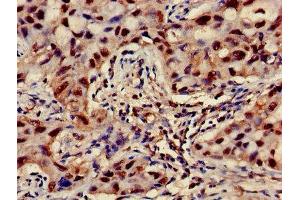 Immunohistochemistry of paraffin-embedded human lung cancer using ABIN7144852 at dilution of 1:100 (ATP5F1D antibody  (AA 32-158))