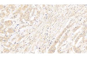 Detection of Surv in Human Breast cancer Tissue using Polyclonal Antibody to Survivin (Surv) (Survivin antibody  (AA 1-142))