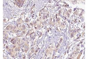 ABIN6267469 at 1/100 staining human breast carcinoma tissue sections by IHC-P. (CDC25C antibody  (pSer216))