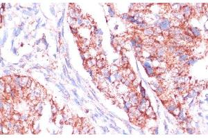 Immunohistochemistry of paraffin-embedded Human colon carcinoma using RPL24 Polyclonal Antibody at dilution of 1:100 (40x lens).