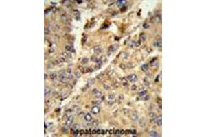 Formalin-fixed and paraffin-embedded human hepatocarcinoma reacted with XDH Antibody (N-term), which was peroxidase-conjugated to the secondary antibody, followed by DAB staining. (XDH antibody  (N-Term))