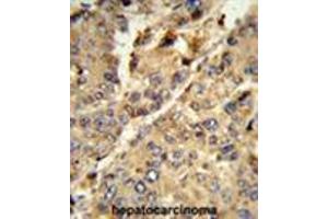 Formalin-fixed and paraffin-embedded human hepatocarcinoma reacted with XDH Antibody (N-term), which was peroxidase-conjugated to the secondary antibody, followed by DAB staining.
