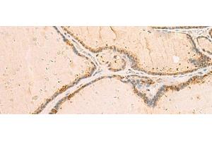 Immunohistochemistry of paraffin-embedded Human thyroid cancer tissue using IP6K3 Polyclonal Antibody at dilution of 1:50(x200) (IP6K3 antibody)