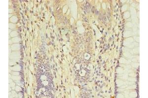 Immunohistochemistry of paraffin-embedded human colon cancer using ABIN7149384 at dilution of 1:100