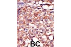 Formalin-fixed and paraffin-embedded human cancer tissue reacted with the primary antibody, which was peroxidase-conjugated to the secondary antibody, followed by AEC staining. (RIPK4 antibody  (C-Term))