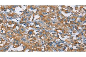 Immunohistochemistry of paraffin-embedded Human thyroid cancer tissue using KLF7 Polyclonal Antibody at dilution 1:40 (KLF7 antibody)