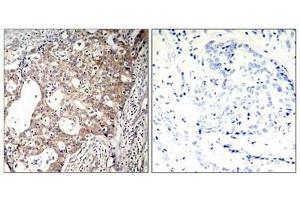 Immunohistochemical analysis of paraffin-embedded human breast carcinoma tissue using Shc1(Phospho-Tyr427) Antibody(left) or the same antibody preincubated with blocking peptide(right). (SHC1 antibody  (pTyr427))