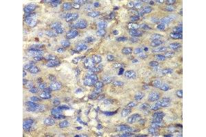 Immunohistochemistry of paraffin-embedded Human liver cancer using SDHA Polyclonal Antibody at dilution of 1:100 (40x lens). (SDHA antibody)