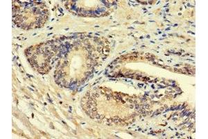 Immunohistochemistry of paraffin-embedded human prostate cancer using ABIN7156008 at dilution of 1:100 (HSD11B1L antibody  (AA 17-87))