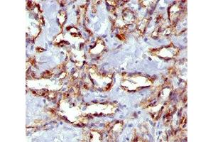 IHC staining of angiosarcoma with PECAM-1 antibody (C31. (CD31 antibody)