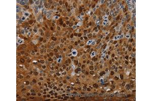 Immunohistochemistry of Human thyroid cancer using NRP2 Polyclonal Antibody at dilution of 1:35