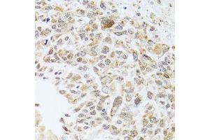 Immunohistochemistry of paraffin-embedded human lung cancer using RNASEL antibody. (RNASEL antibody  (AA 472-741))