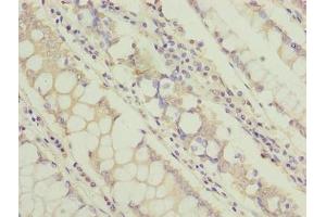 Immunohistochemistry of paraffin-embedded human colon cancer using ABIN7171349 at dilution of 1:100 (TCTA antibody  (AA 62-103))