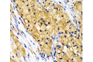 Immunohistochemistry of paraffin-embedded Human lung cancer using CAPG Polyclonal Antibody at dilution of 1:100 (40x lens). (CAPG antibody)