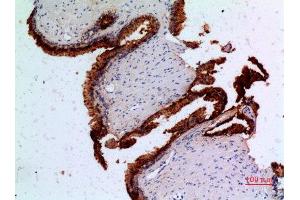 Immunohistochemistry (IHC) analysis of paraffin-embedded Human Prostatic Cancer, antibody was diluted at 1:100. (Angiopoietin 1 antibody  (N-Term))