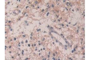 Detection of IL35 in Human Glioma Tissue using Polyclonal Antibody to Interleukin 35 (IL35) (Interleukin 35 antibody  (AA 23-219))