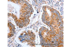 Immunohistochemistry of Human liver cancer using CLDN10 Polyclonal Antibody at dilution of 1:50