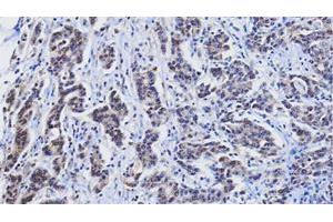 Paraffin embedded sections of human gastric cancer tissue were incubated with RBP4 monoclonal antibody, clone AT2B4 (Cat # MAB3211 ; 1 : 25) for 2 hours at room temperature. (RBP4 antibody  (AA 19-201))