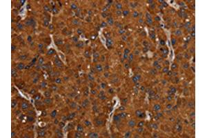 The image on the left is immunohistochemistry of paraffin-embedded Human liver cancer tissue using ABIN7192423(SLC22A12 Antibody) at dilution 1/20, on the right is treated with synthetic peptide. (SLC22A12 antibody)