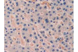 DAB staining on IHC-P; Samples: Human Liver cancer Tissue (TRF1 antibody  (AA 148-428))