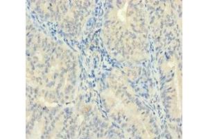 Immunohistochemistry of paraffin-embedded human endometrial cancer using ABIN7176084 at dilution of 1:100 (ZMAT5 antibody  (AA 1-170))