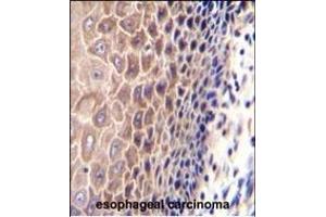 CCDC97 Antibody (C-term) (ABIN655301 and ABIN2844887) immunohistochemistry analysis in formalin fixed and paraffin embedded human esophageal carcinoma followed by peroxidase conjugation of the secondary antibody and DAB staining. (CCDC97 antibody  (C-Term))