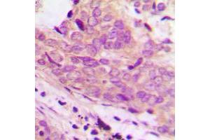 Immunohistochemical analysis of 42064 staining in human prostate cancer formalin fixed paraffin embedded tissue section. (MARCH1 antibody  (Center))