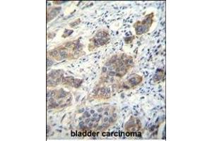 CDH24 Antibody (N-term) (ABIN656094 and ABIN2845437) immunohistochemistry analysis in formalin fixed and paraffin embedded human bladder carcinoma followed by peroxidase conjugation of the secondary antibody and DAB staining.