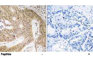 Immunohistochemistry analysis of paraffin-embedded human colon carcinoma tissue using DAP polyclonal antibody .