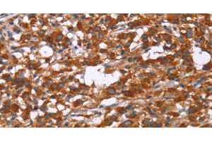 Immunohistochemistry of paraffin-embedded Human thyroid cancer tissue using GPHN Polyclonal Antibody at dilution 1:30 (Gephyrin antibody)