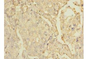 Immunohistochemistry of paraffin-embedded human lung cancer using ABIN7158886 at dilution of 1:100 (MARCO antibody  (AA 421-520))