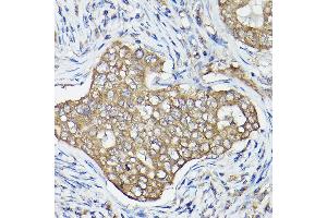 Immunohistochemistry of paraffin-embedded human breast cancer using OL Rabbit pAb (1671) at dilution of 1:100 (40x lens). (OLA1 antibody  (AA 297-396))