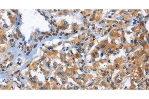 Immunohistochemistry of paraffin-embedded Human thyroid cancer using CD244 Polyclonal Antibody at dilution of 1:50 (2B4 antibody)