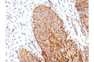 Formalin-fixed, paraffin-embedded human Bladder Carcinoma stained with Thrombomodulin Monoclonal/CD141 Antibody (THBD/1591). (Thrombomodulin antibody  (AA 69-194))