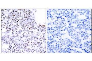 Immunohistochemical analysis of paraffin-embedded human breast carcinoma tissue using SMC1 (Ab-957) antibody (E021190). (SMC1A antibody)
