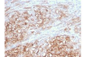 Formalin-fixed, paraffin-embedded human Melanoma stained with MCAM Mouse Monoclonal Antibody (MCAM/3046). (MCAM antibody  (AA 226-374))