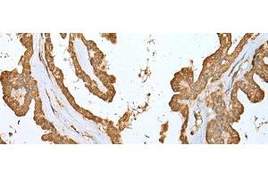 Immunohistochemistry of paraffin-embedded Human thyroid cancer tissue using ALKBH8 Polyclonal Antibody at dilution of 1:25(x200)