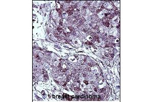 TYSY Antibody (C-term) immunohistochemistry analysis in formalin fixed and paraffin embedded human breast carcinoma followed by peroxidase conjugation of the secondary antibody and DAB staining.