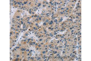Immunohistochemistry of Human liver cancer using SYN2 Polyclonal Antibody at dilution of 1:40 (SYN2 antibody)