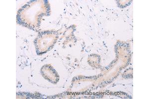 Immunohistochemistry of Human thyroid cancer using MAP3K12 Polyclonal Antibody at dilution of 1:30