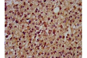 IHC image of ABIN7150649 diluted at 1:200 and staining in paraffin-embedded human glioma performed on a Leica BondTM system. (DSCAM antibody  (AA 1711-1867))