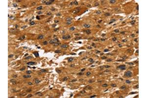 The image on the left is immunohistochemistry of paraffin-embedded Human liver cancer tissue using ABIN7192726(TACC2 Antibody) at dilution 1/30, on the right is treated with synthetic peptide. (TACC2 antibody)