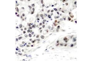 Immunohistochemistry (IHC) image for anti-Estrogen Receptor 1 (ESR1) (pSer106) antibody (ABIN3020205) (Estrogen Receptor alpha antibody  (pSer106))