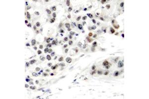 Immunohistochemistry (IHC) image for anti-Estrogen Receptor 1 (ESR1) (pSer106) antibody (ABIN3020205)
