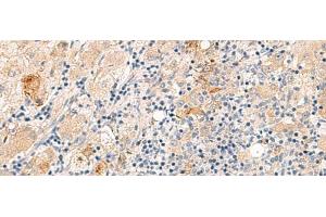 Immunohistochemistry of paraffin-embedded Human liver cancer tissue using THNSL1 Polyclonal Antibody at dilution of 1:70(x200) (THNSL1 antibody)
