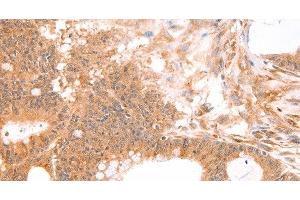 Immunohistochemistry of paraffin-embedded Human colon cancer tissue using TNF beta Polyclonal Antibody at dilution 1:50 (LTA antibody)