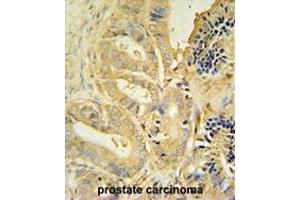 TLL1 antibody (C-term) immunohistochemistry analysis in formalin fixed and paraffin embedded human prostate carcinoma followed by peroxidase conjugation of the secondary antibody and DAB staining. (TLL1 antibody  (C-Term))